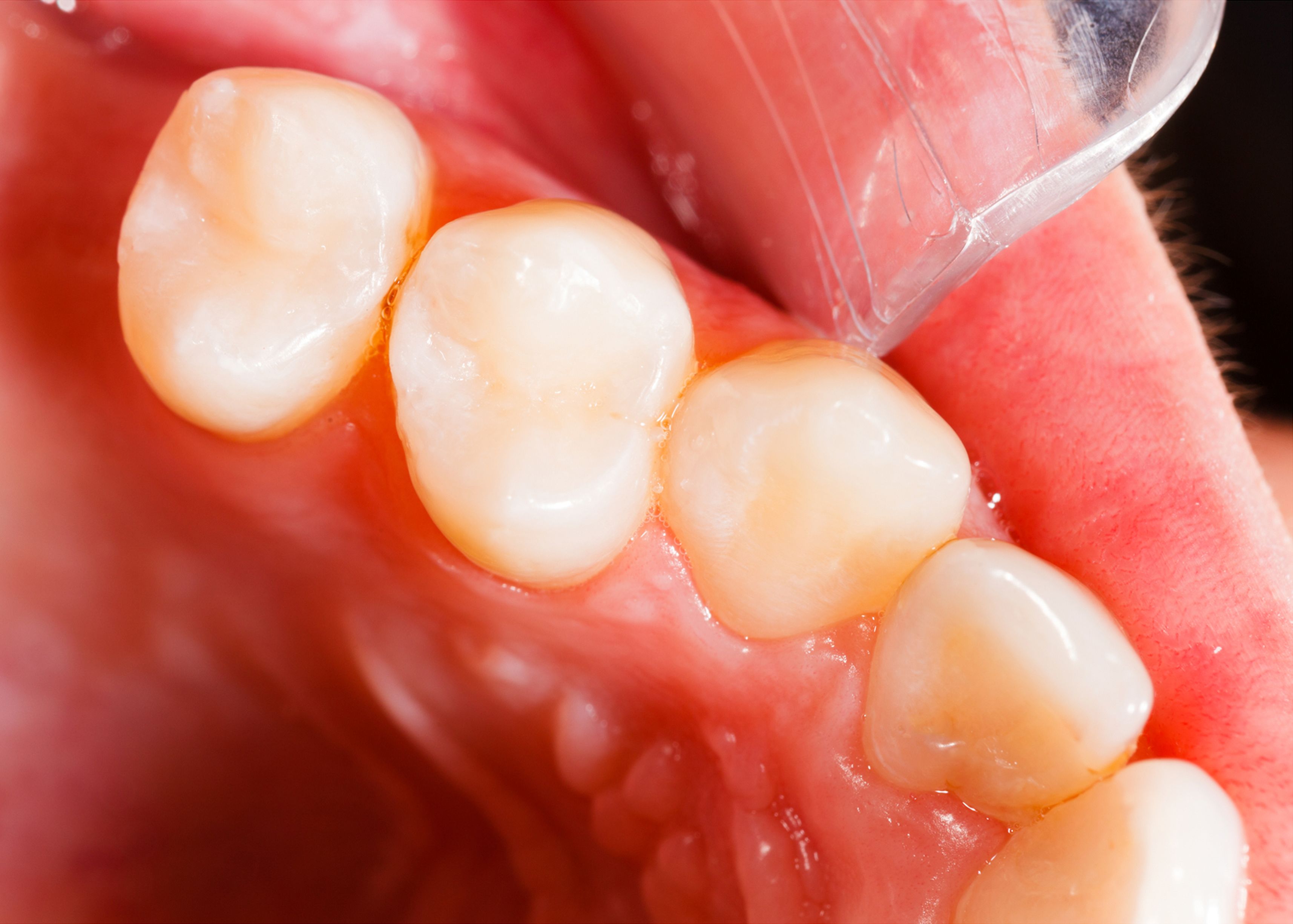 Close-up of a patient's mouth