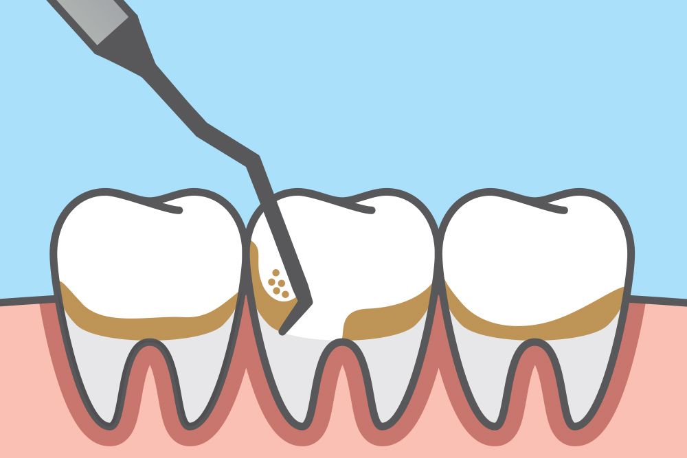 a dental pick removing debris from below the gum line