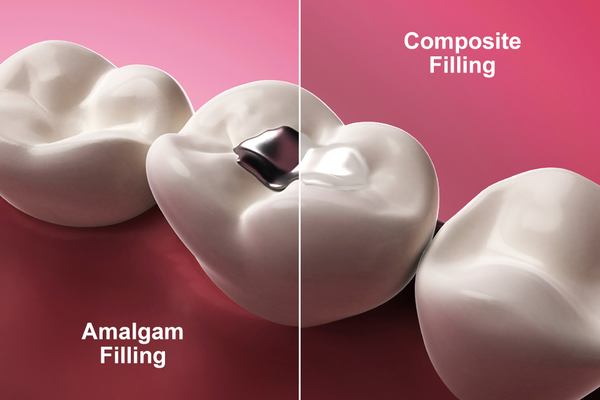 Side by side image of a silver amalgam filling compared to a composite filling