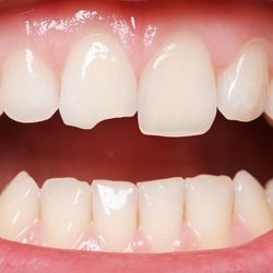Illustration of a chipped front tooth