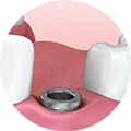 Placing the Implant