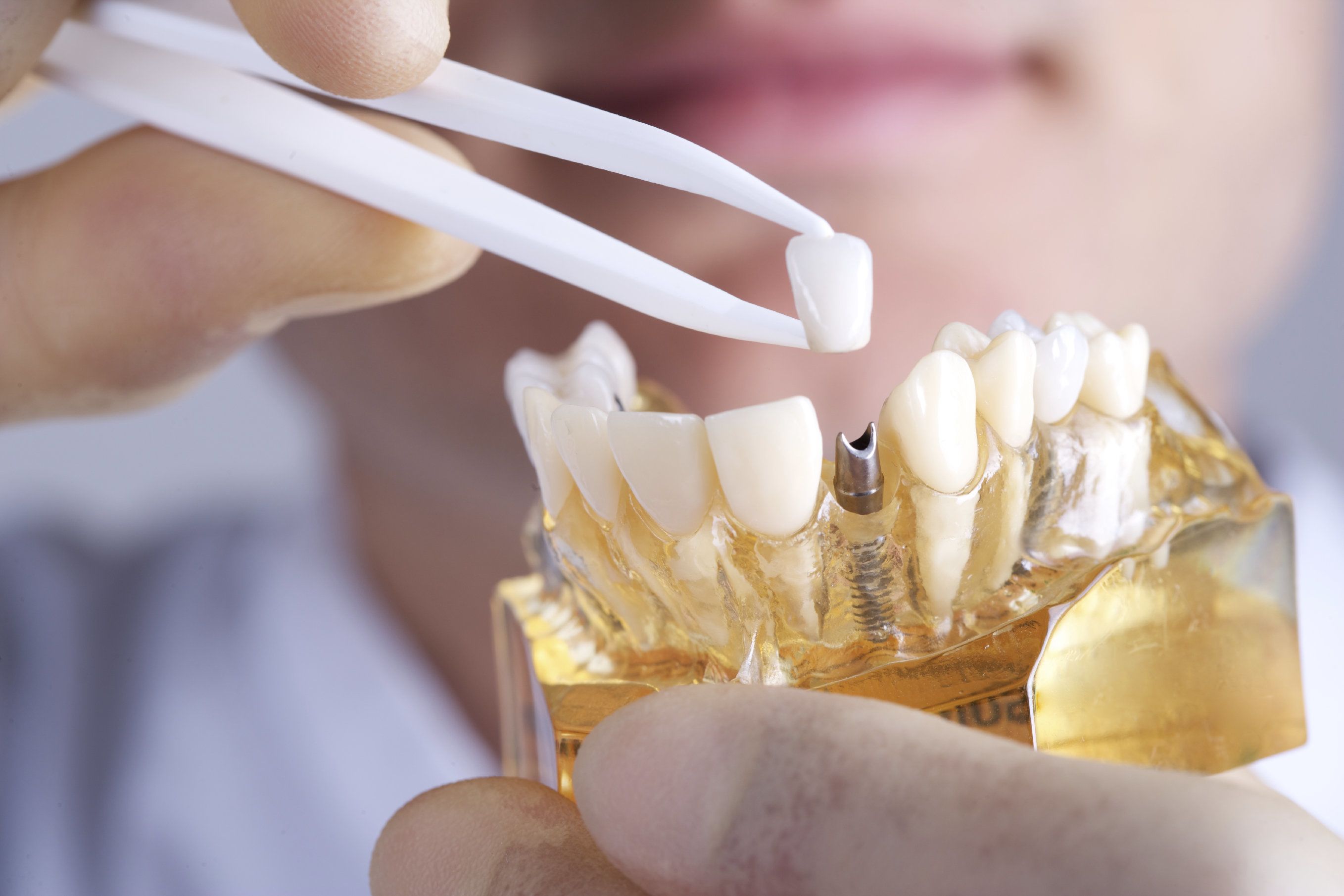 an older woman smiles brightly after receiving dental implants